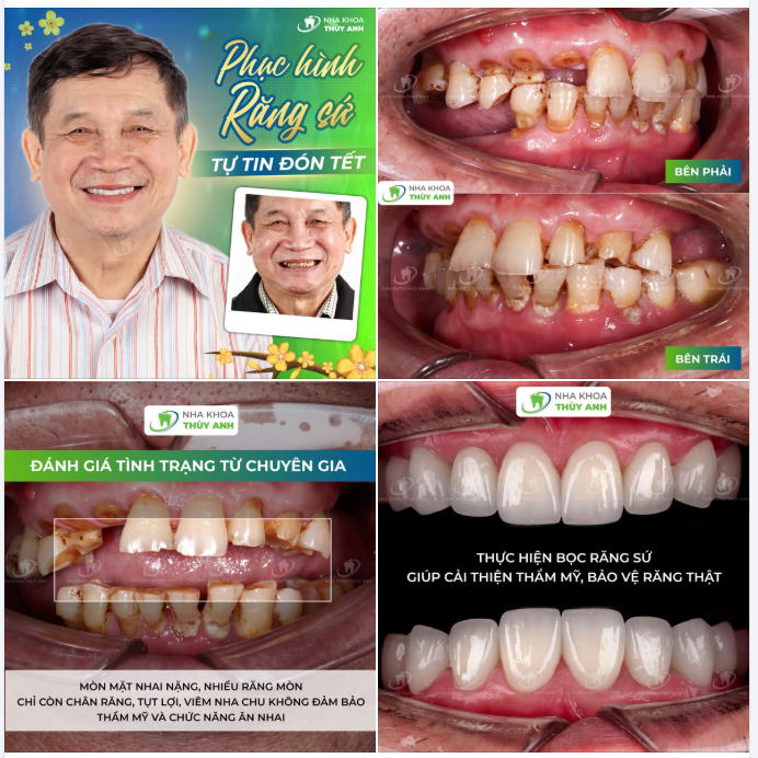 TỰ TIN CƯỜI RẠNG RỠ Ở BẤT KỲ ĐỘ TUỔI NÀO VỚI HÀM RĂNG KHOẺ - ĐẸP