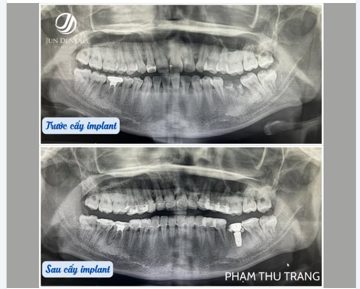 CẤY IMPLANT KHÔNG SƯNG – KHÔNG ĐAU – KHÔNG CẦN NGHỈ DƯỠNG