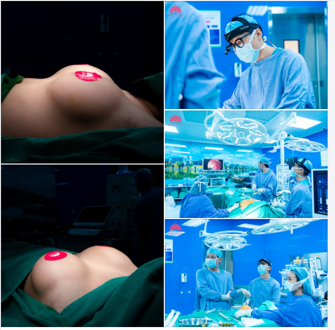 Hô biến “teo lép” - "Phù phép" V1 căng tròn, mềm mại tự nhiên