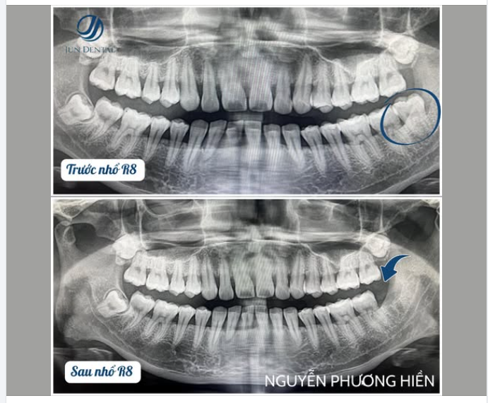 NHỔ RĂNG KHÔN (RĂNG CHỈ 30 GIÂY – NHẸ NHÀNG – KHÔNG SƯNG ĐAU