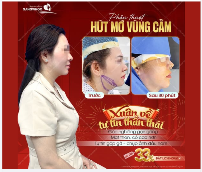 XUÂN VỀ TỰ TIN THẦN THÁI ​​​​​​​  Phẫu thuật hút mỡ vùng cằm