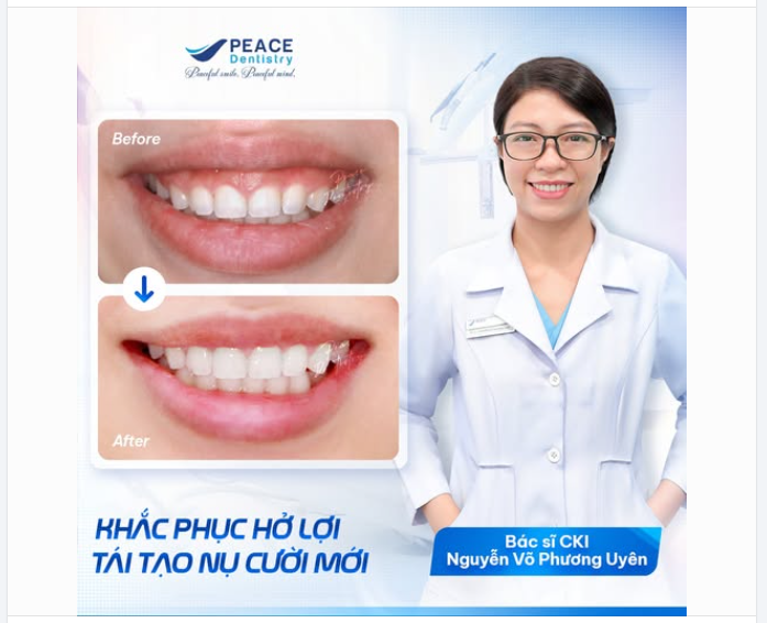 ĐIỀU TRỊ CƯỜI LỘ NƯỚU, TÁI THIẾT LẬP THẨM MỸ NỤ CƯỜI