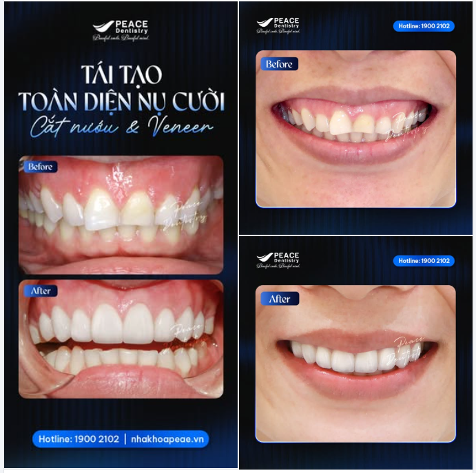 GIẢI PHÁP HOÀN HẢO CHO NỤ CƯỜI RẠNG RỠ