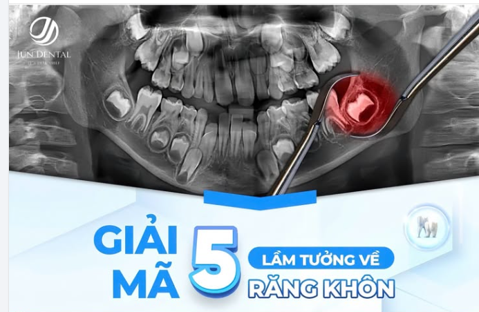 GIẢI MÃ 5 LẦM TƯỞNG PHỔ BIẾN VỀ RĂNG KHÔN