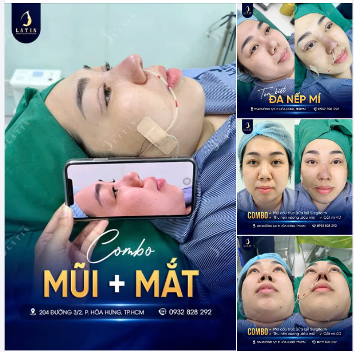 LỘT XÁC TOÀN DIỆN SAU 60 PHÚT COMBO MŨI & MẮT MỚI RA LÒ