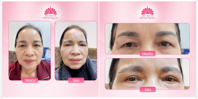 1 THÁNG SAU CẮT DA THỪA MÍ TRÊN, DƯỚI - NẾP MÍ TỰ NHIÊN, SẸO "TÀNG HÌNH" NHƯ CHƯA HỀ CAN THIỆP