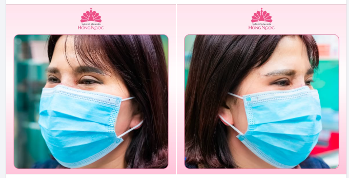 TÁI KHÁM SAU 7 NGÀY PHẪU THUẬT NÂNG CUNG MÀY - KẾT QUẢ KHIẾN KHÁCH HÀNG AN TÂM