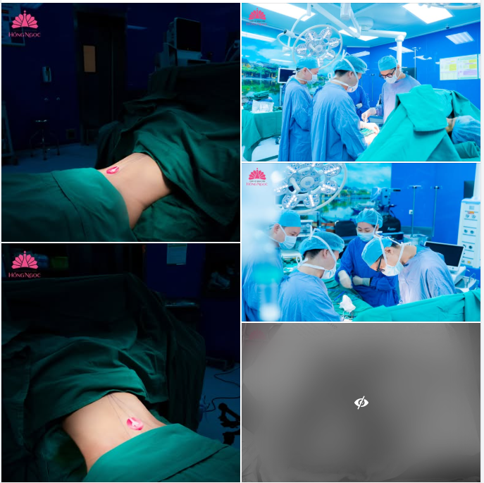 HÚT MỠ TẠO HÌNH THÀNH BỤNG - GIẢI PHÁP LẤY LẠI VÓC DÁNG GỌN GÀNG CHO CƠ ĐỊA KHÓ GIẢM