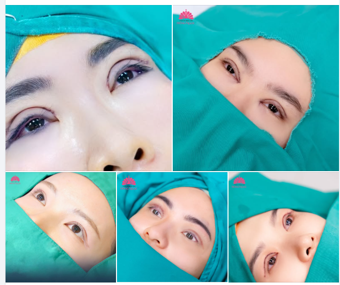 CẮT MÍ HÀN QUỐC - CHỈ TỪ 45 PHÚT THỰC HIỆN - KHÔNG CẦN NGHỈ DƯỠNG - 7 NGÀY ĐẸP TỰ NHIÊN