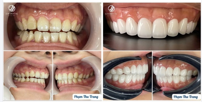 CASE THẨM MỸ – CHỊ PHẠM THU TRANG