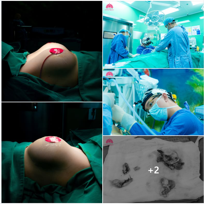 ĐỪNG ĐỂ BAO XƠ “PHÁ DÁNG” VÒNG 1 - NHẬN BIẾT SỚM ĐỂ XỬ LÝ KỊP THỜI