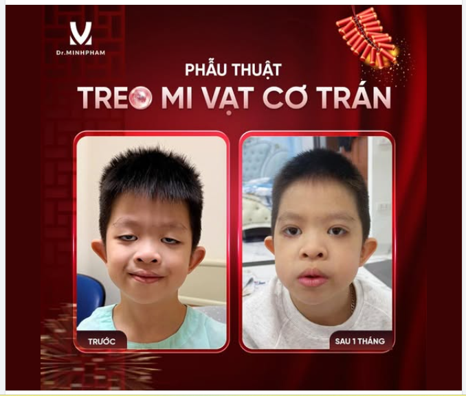 Treo mi vạt cơ trán 2 mắt – Sau 1 tháng của bé Mạnh Phát