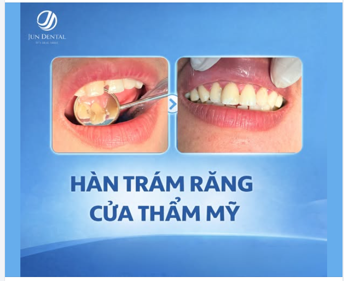 HÀN TRÁM RĂNG CỬA THẨM MỸ – LẤY LẠI NỤ CƯỜI TỰ TIN