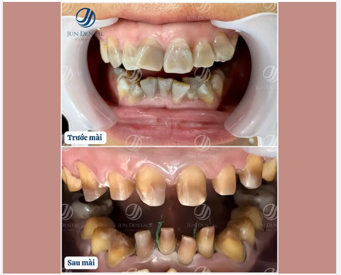 Khách hay hỏi:  “Làm răng sứ tại Jun Dental có phải mài nhiều không?”