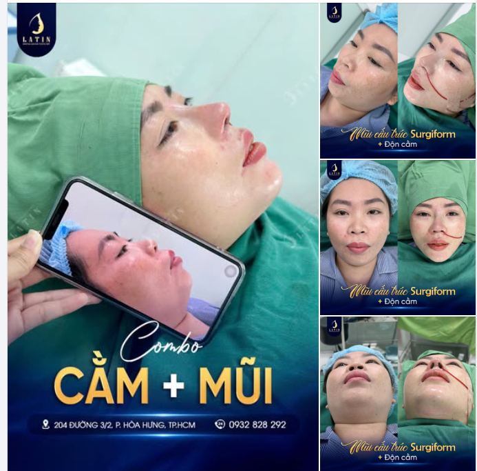GÓC NGHIÊNG TỈ LỆ VÀNG: COMBO MŨI CẤU TRÚC SURGIFORM ĐỘN CẰM SỤN MỸ