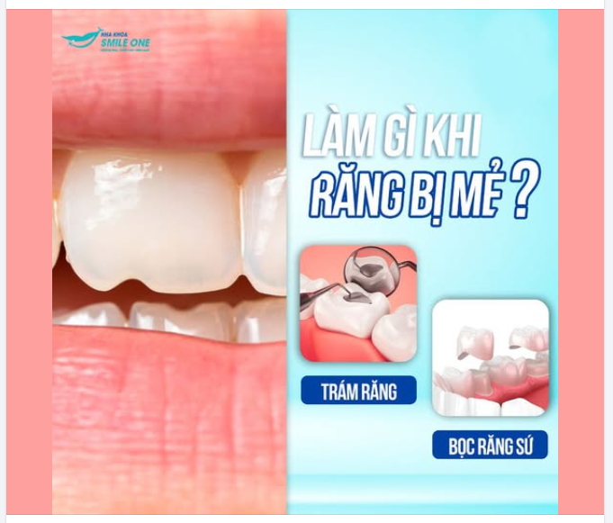 RĂNG BỊ MẺ – ĐÂU LÀ GIẢI PHÁP TỐI ƯU?