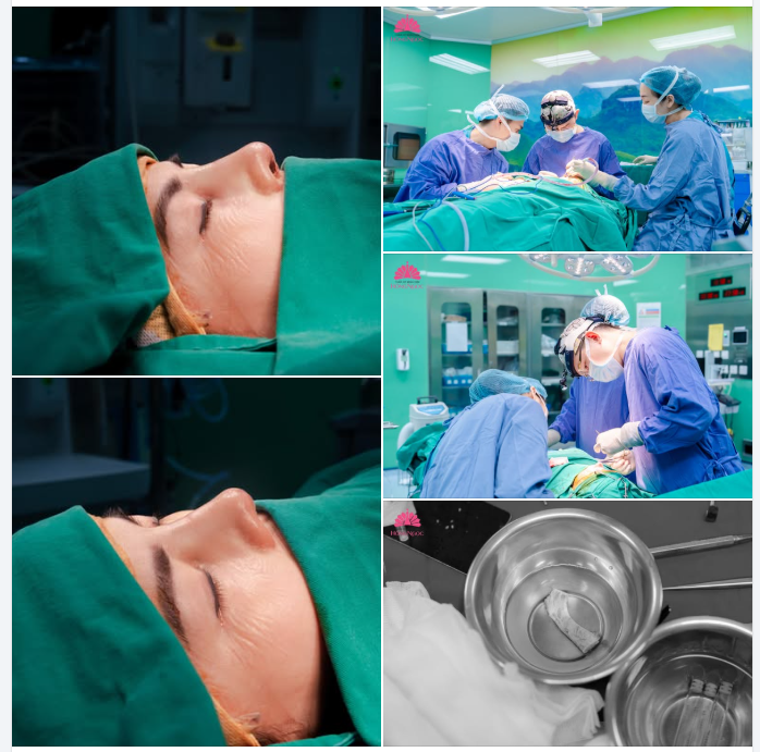 XỬ TRÍ MŨI BIẾN DẠNG SAU NHIỀU LẦN PHẪU THUẬT BẰNG PHƯƠNG PHÁP NÂNG MŨI CẤU TRÚC SỤN SƯỜN