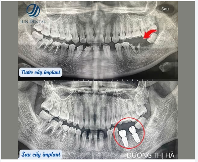 IMPLANT TẠI JUN DENTAL – KHÔNG CÓ CA GIỐNG NHAU
