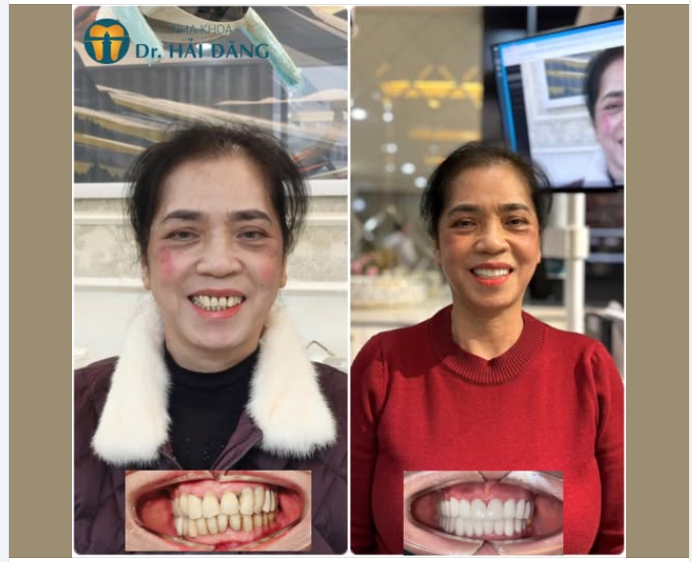 LỘT XÁC NỤ CƯỜI – TRẺ HƠN CẢ CHỤC TUỔI