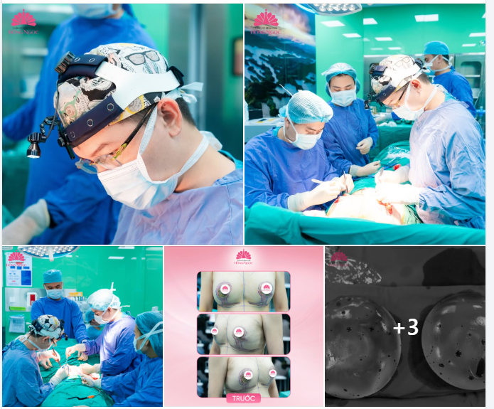 XỬ LÝ BIẾN CHỨNG NẶNG SAU 2 THÁNG NÂNG NGỰC TẠI CƠ SỞ TM THIẾU UY TÍN