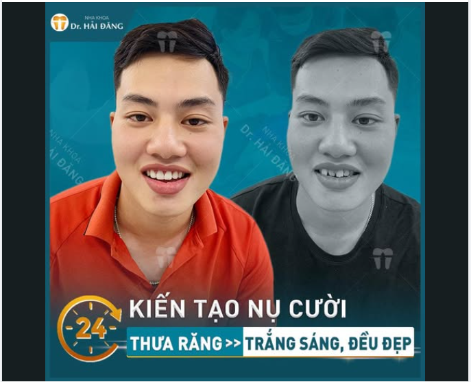 RĂNG THƯA – XỈN MÀU ĐỪNG ĐỂ NỤ CƯỜI KÉM DUYÊN THÊM NỮA!
