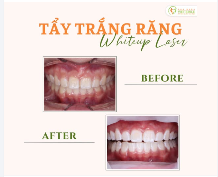 TẾT CẬN KỀ – CƯỜI RẠNG RỠ VỚI NỤ CƯỜI TRẮNG SÁNG