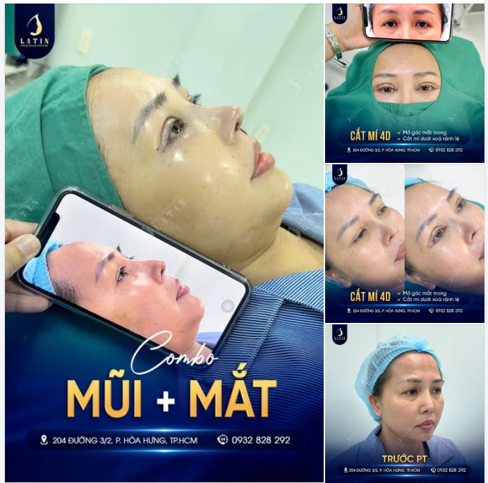 TẠM BIỆT ĐÔI MẮT CHÂN CHIM, RÃNH LỆ SÂU – TRẺ RA 10 TUỔI SAU 1 LẦN LÀM ĐẸP
