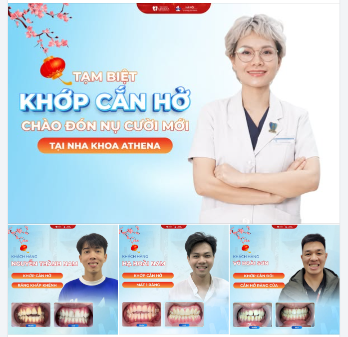 NIỀNG RĂNG AI MAX SPEED: GIẢI PHÁP "VÀNG" CHO TÌNH TRẠNG KHỚP CẮN HỞ TẠI NHA KHOA ATHENA