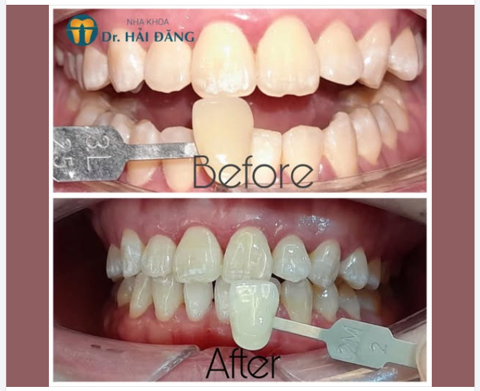 TẨY TRẮNG RĂNG – LỘT XÁC NỤ CƯỜI ĐÓN NĂM MỚI