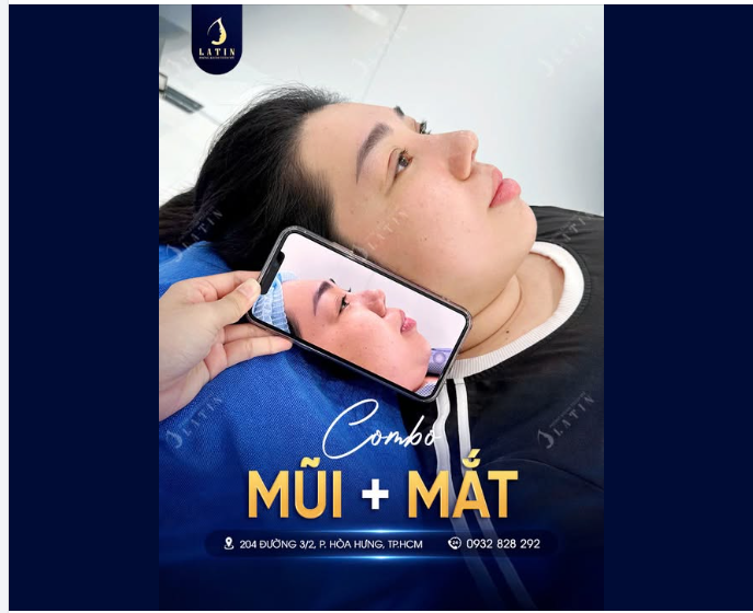 XÓA ĐA NẾP MÍ NÂNG MŨI CẤU TRÚC SỬA LẠI SURGIFORM  GƯƠNG MẶT THANH THOÁT, RẠNG NGỜI TỰ TIN