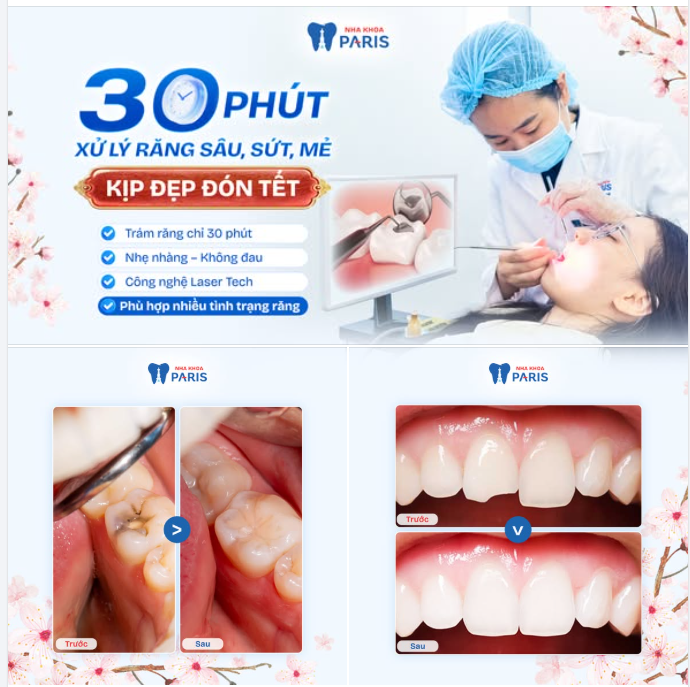 30 PHÚT RĂNG ĐẸP TỨC THÌ – KỊP ĂN TẾT!