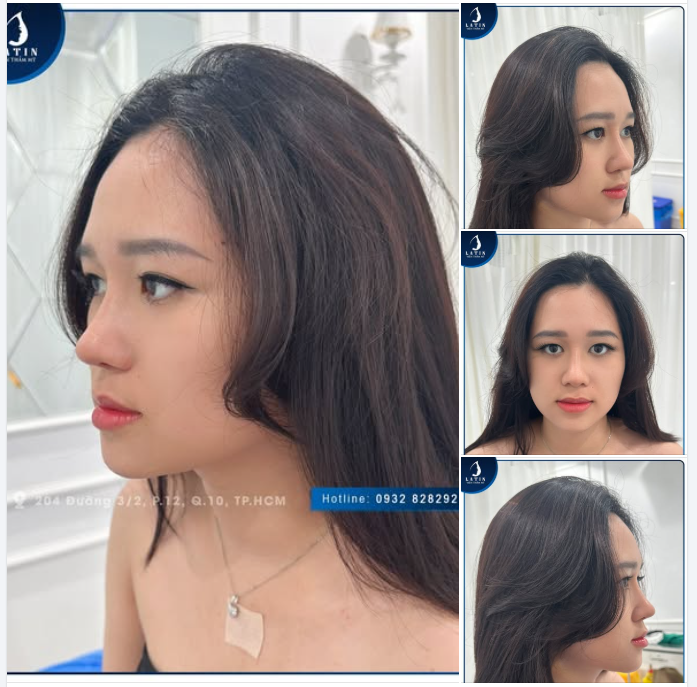 Mũi bán cấu trúc 10 ngày đẹp trọn “10 điểm” và KHÔNG CÓ NHƯNG