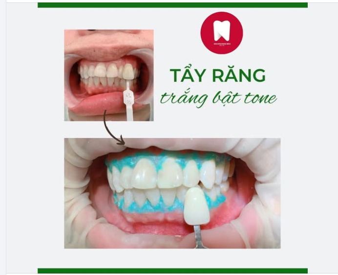 TỰ TIN TỎA SÁNG VỚI NỤ CƯỜI TRẮNG SÁNG