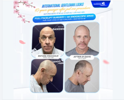 Không ồn ào, không phô trương — vị quý ông quốc tế lựa chọn trẻ hóa vì một lý do rất đơn giản: ​​​​​​​ Muốn diện mạo phản ánh đúng phong độ và vị thế của mình.