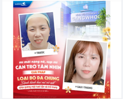 MÍ MẮT NẶNG NỀ, SỤP MÍ – KHÔNG CHỈ LÀ VẤN ĐỀ THẨM MỸ