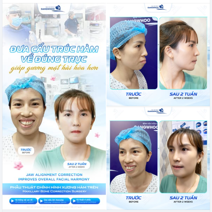 ĐƯA CẤU TRÚC HÀM VỀ ĐÚNG TRỤC GIÚP GƯƠNG MẶT HÀI HÒA HƠN