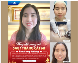 THAY ĐỔI RẠNG RỠ SAU 1 THÁNG – MẮT ĐẸP ĐÓN TẾT SANG