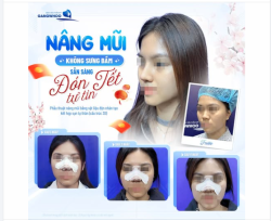 Chỉ còn đếm ngược vài ngày nữa là đến Tết, bạn vẫn đang lo lắng nâng mũi sẽ bị sưng bầm, lâu hồi phục?