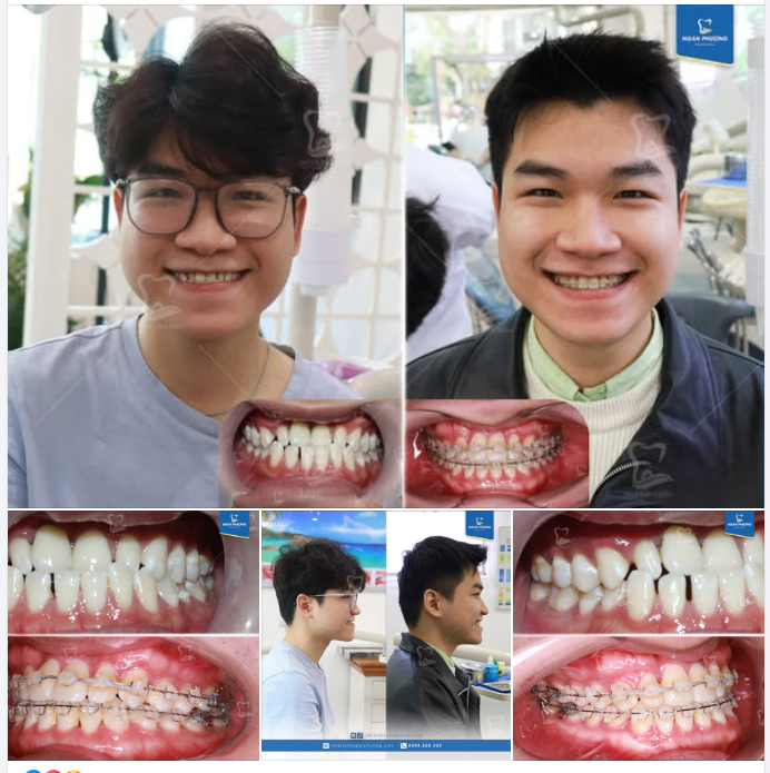 Chúc mừng Thế Long tháo niềng đón Tết