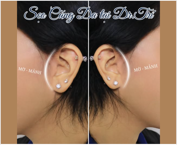 CĂNG DA MẶT: SỢ SẸO XẤU HAY KHÁT KHAO THANH XUÂN?