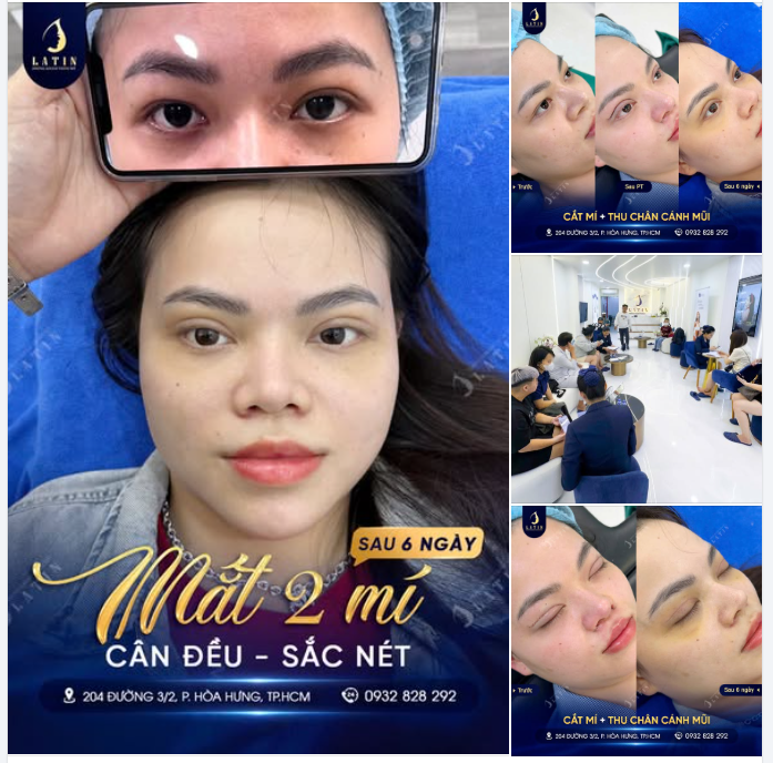 RECAP 6 NGÀY – COMBO MẮT MŨI ĐẸP "THẦN TỐC" – TỰ TIN XUỐNG PHỐ SAU CẮT CHỈ
