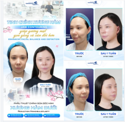 TINH CHỈNH XƯƠNG HÀM GIÚP GƯƠNG MẶT GỌN GÀNG VÀ CÂN ĐỐI HƠN