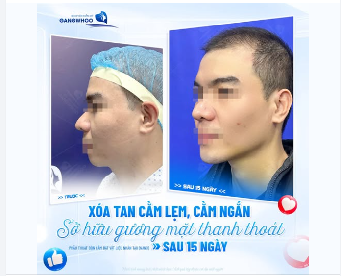 XÓA TAN CẰM LẸM, CẰM NGẮN