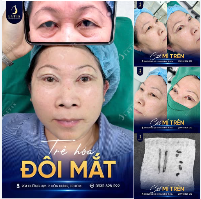 TRẺ HÓA ĐÔI MẮT TUỔI 66: ĐẸP TỰ NHIÊN, KHỎE TẦM NHÌN