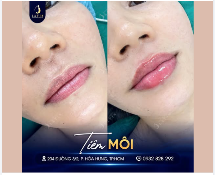 CẬN CẢNH BỜ MÔI CĂNG MỌNG, CUỐN HÚT CHỈ SAU 30 PHÚT