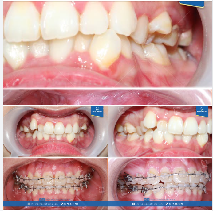Thục Anh tháo niềng, 10 điểm không có nhưng