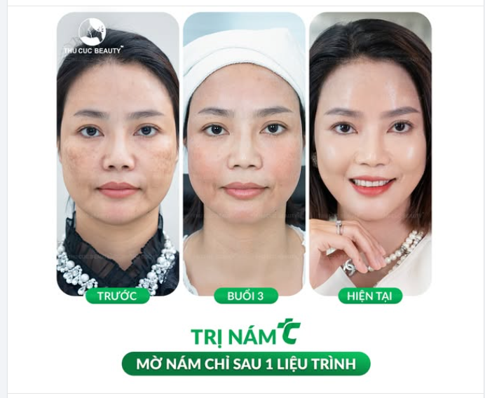 PICOSURE PRO – “CHIẾN BINH THẦN KỲ” TRONG ĐIỀU TRỊ NÁM, CÔNG NGHỆ LASER TIÊN TIẾN NHẤT TỪ MỸ