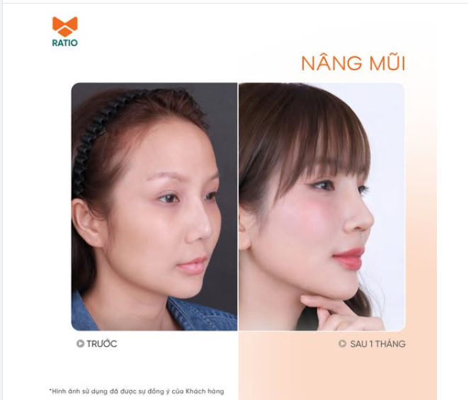 Bao lâu sau nâng mũi thì form thật sự ổn định?