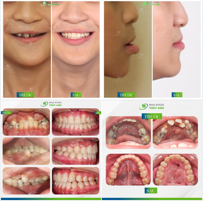 CASE CHỈNH NHA CẮN NGƯỢC PHỨC TẠP TRÊN BỆNH NHÂN CÓ TIỀN SỬ KHE HỞ MÔI + THIẾU HỤT XƯƠNG HÀM TRÊN