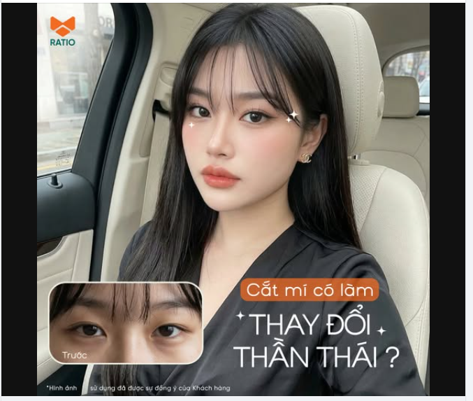 Cắt mí có làm thay đổi thần thái không?  Câu trả lời là: có, nhưng không phải theo cách nhiều người vẫn nghĩ.